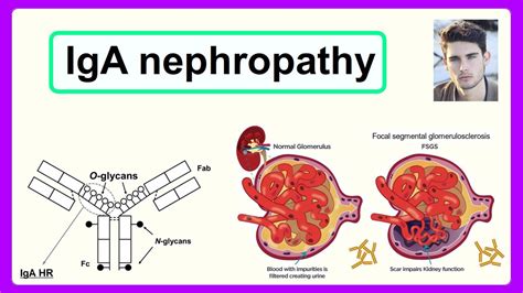 iga nephropathy nhs